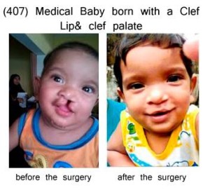 466 medical baby born with a clef lip clef palate