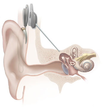 (393) Master Mohamed Shamry for Cochlear Implant